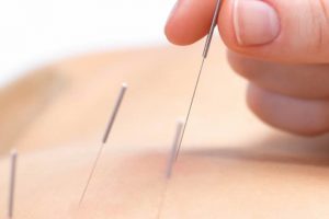 dry needles needling