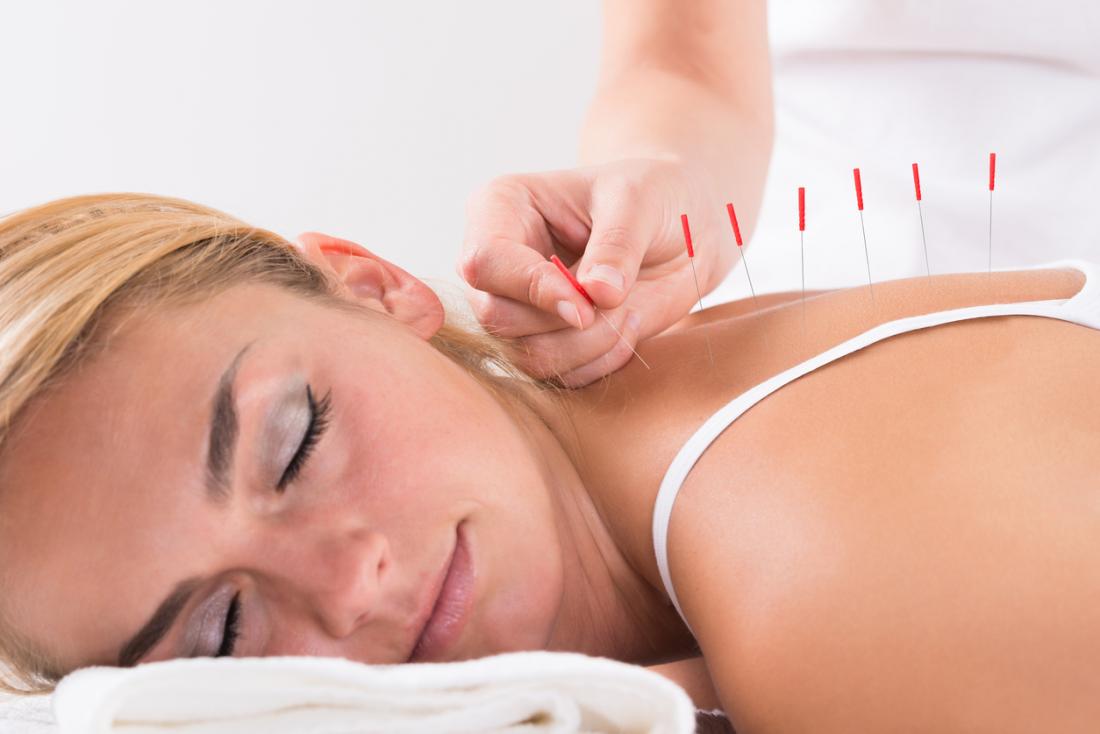 woman-being-treated-with-acupuncture.jpg